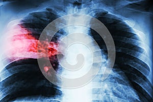 Lobar pneumonia . film chest x-ray show alveolar infiltration at right middle lobe due to tuberculosis infection .