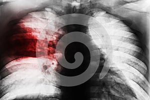 Lobar Pneumonia photo