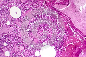 Lobar pneumonia, hemorrhagic edema period