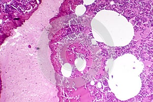 Lobar pneumonia, hemorrhagic edema period