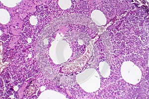 Lobar pneumonia, hemorrhagic edema period