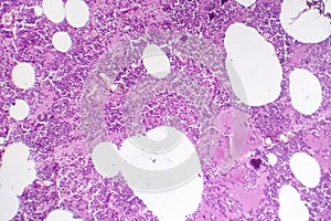 Lobar pneumonia, hemorrhagic edema period