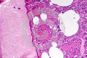 Lobar pneumonia, hemorrhagic edema period