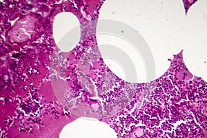 Lobar pneumonia, hemorrhagic edema period