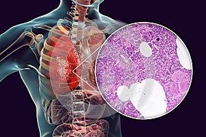 Lobar pneumonia, hemorrhagic edema period