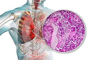 Lobar pneumonia, hemorrhagic edema period