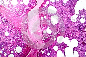 Lobar pneumonia during the hemorrhagic edema period, light micrograph