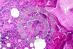 Lobar pneumonia during the hemorrhagic edema period, light micrograph