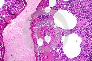 Lobar pneumonia during the hemorrhagic edema period, light micrograph