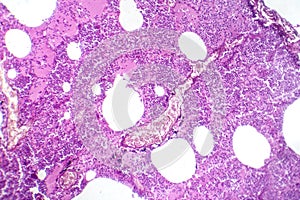 Lobar pneumonia during the hemorrhagic edema period, light micrograph