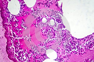 Lobar pneumonia during the hemorrhagic edema period, light micrograph