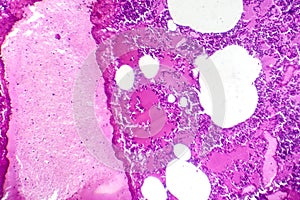 Lobar pneumonia during the hemorrhagic edema period, light micrograph