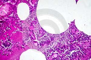 Lobar pneumonia during the hemorrhagic edema period, light micrograph