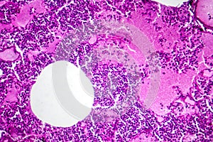 Lobar pneumonia during the hemorrhagic edema period, light micrograph