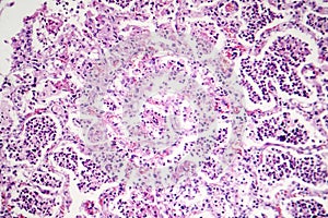 Lobar pneumonia, red hepatic phase photo