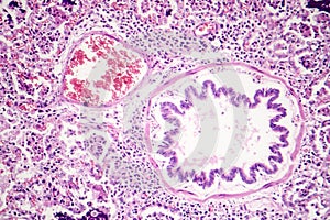 Lobar pneumonia, red hepatic phase photo