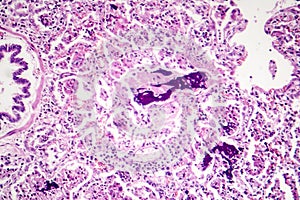 Lobar pneumonia, red hepatic phase photo