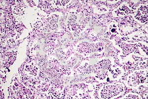 Lobar pneumonia, red hepatic phase