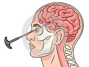 Lobotomy diagram medical science