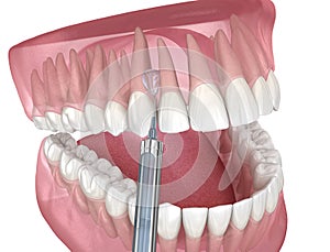 Local Dental anesthesia. 3D illustration of dental treatment