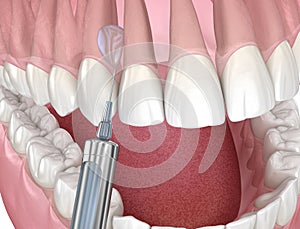 Local Dental anesthesia. 3D illustration of dental treatment