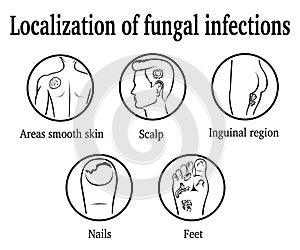 The localization of fungal infections