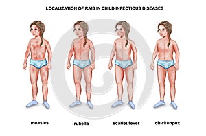 localization of rash in child infectious diseases