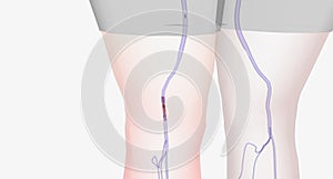 Location of Deep Vein Thrombosis