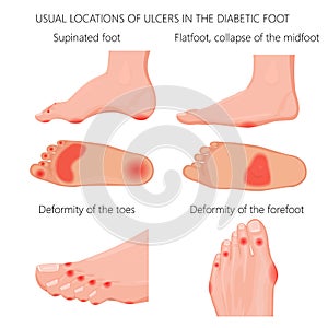 Location of the Diabetic foot ulcers