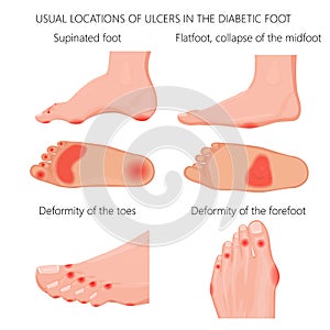 Location of the Diabetic foot ulcers photo