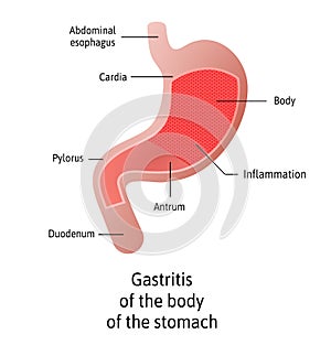 Location of Gastritis, body of it, an inflammation of the lining of the stomach. Three types Antral, of the body and pangastritis