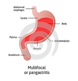 Location of Gastritis, multifocal, an inflammation of the lining of the stomach. Three types Antral, of the body and