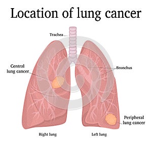 Location of lung cancer