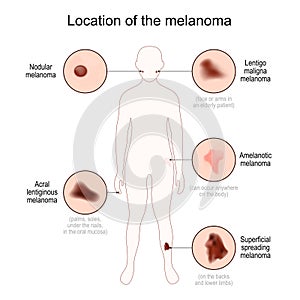Location of the melanoma. Close-up of malignant skin cancer