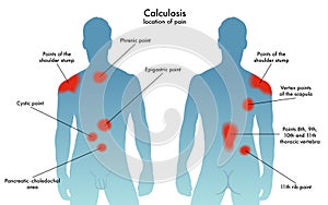 Location of pain of calculosis