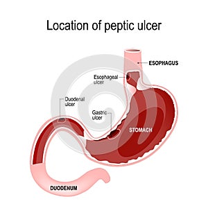 Location of peptic ulcer