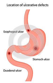 Location of ulcerative defects