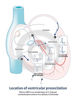 Location of ventricular preexcitation photo