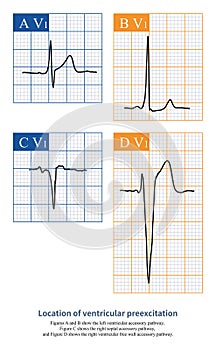 Location of ventricular preexcitation photo