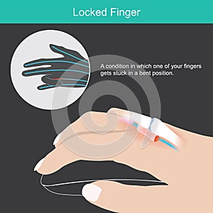 Locked Finger. This picture showing human of hand and sample caused of which one of your fingers gets stuck