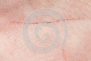 Long cut scratch on human skin