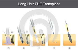 Long Hair FUE Transplant. photo