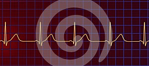 Long QT syndrome ECG, 3D illustration photo