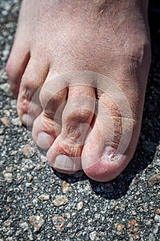 Looking down at a man`s foot that is missing the big toe nail