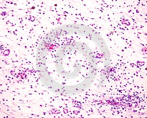 Loose connective tissue. Chronic inflammation