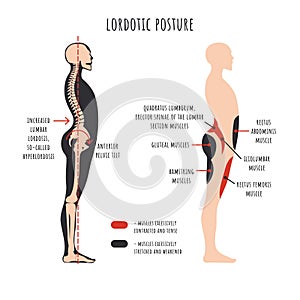 Lordotic posture. Side view shows hyperlordosis deformation, spine curvature, pelvis rotation, stretched and weakened, shortened