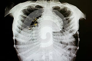 pulmonary tuberculosis photo