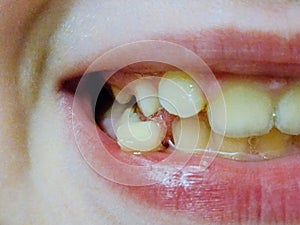Loss of baby teeth in children and teenagers.