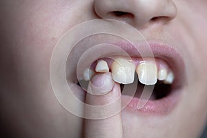 loss of a baby tooth in an eight-year-old child  at the last stage