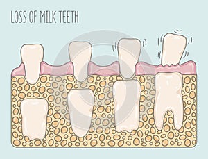 Loss of milk teeth